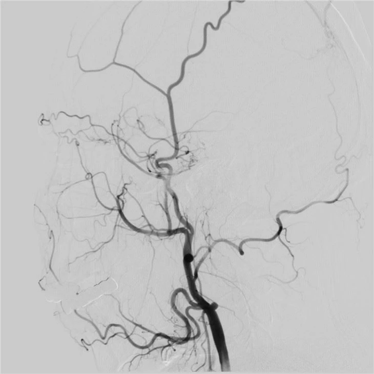Neuro Angiography Machine